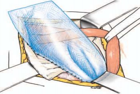 Hình 2 6 Khâu cố định tấm lưới vào dây chằng bẹn mũi khâu vắt Nguồn 6