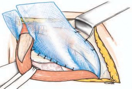 Hình 2 7 Hai vạt tấm lưới ôm lấy thừng tinh cố định vào cơ chéo bụng trong 1