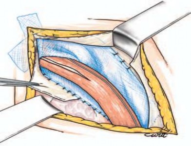 Hình 2 9 Đặt thừng tinh trên tấm lưới Nguồn Pélissier E Palot J P Ngo P 2007 132 3
