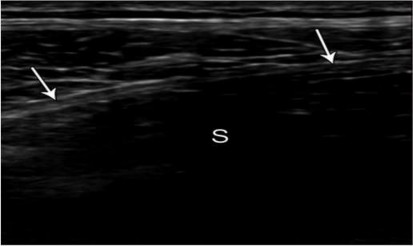 Hình 2 10 Tấm lưới ở vùng bẹn phải Siêu âm khó nhìn thấy và xuất hiện với 6