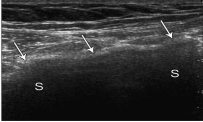 Hình 2 11 Tấm lưới đặt ở vùng bẹn phải siêu âm xuất hiện tấm lưới tăng 7