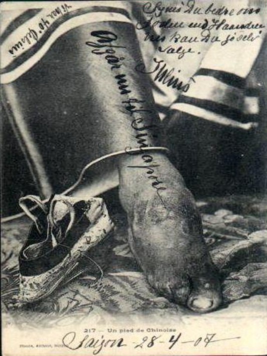 Phụ lục 10 Hình một bàn chân bị bó từ nhỏ của phụ nữ người Hoa Nguồn 5