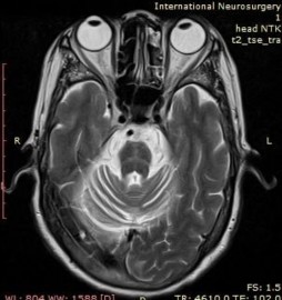MRI não ghi nhận teo cầu não và tiểu não với dấu bánh ngọt chữ thập Test 1
