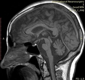 MRI não ghi nhận teo cầu não và tiểu não với dấu bánh ngọt chữ thập Test 2