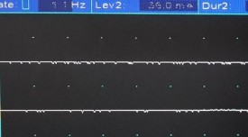 A B C D Test chức năng thần kinh tự chủ A không có sóng đáp ứng giao cảm da B 3
