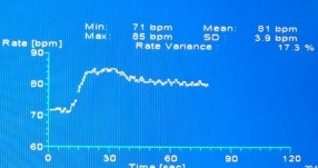 B C D Test chức năng thần kinh tự chủ A không có sóng đáp ứng giao cảm da B tỷ 4