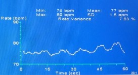C D Test chức năng thần kinh tự chủ A không có sóng đáp ứng giao cảm da B tỷ 5