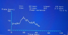 D Test chức năng thần kinh tự chủ A không có sóng đáp ứng giao cảm da B tỷ số 6