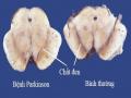 Bệnh Học Các Giai Đoạn Tổn Thương Não Của Bệnh Parkinson