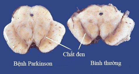 Hình 1 2 Bệnh học bệnh Parkinson Nguồn Ian RAM 2001 65 Bệnh Parkinson đặc trưng 1