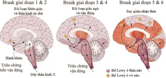 Hình 1 4 Bệnh học các giai đoạn tổn thương não của bệnh Parkinson Nguồn Doty RL 3