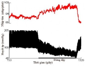 b Hình 1 12 Test biến thiên nhịp tim và huyết áp khi thay đổi tư thế a Đáp ứng 2