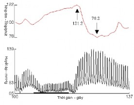 a b Hình 1 13 Test đáp ứng nhịp tim với nghiệm pháp Valsalva a Đáp ứng nhịp tim 3