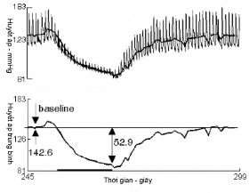 b Hình 1 13 Test đáp ứng nhịp tim với nghiệm pháp Valsalva a Đáp ứng nhịp tim và 4