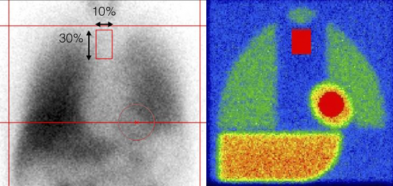 Hình 1 17 Vùng quan tâm của tim hình tròn và trung thất hình vuông theo mặt cắt 7