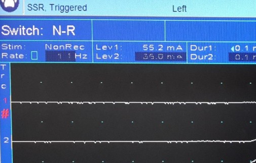 Hình 2 10 Không có sóng đáp ứng với test ghi đáp ứng giao cảm da Nguồn bệnh 10
