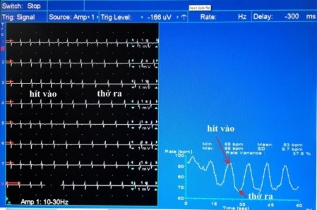 Hình 2 2 Biến thiên nhịp tim bình thường khi hít thở sâu ∆HR 21 nhịp phút 2
