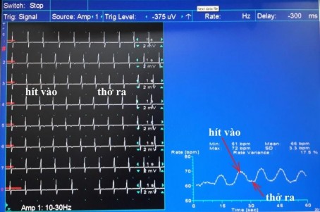 Hình 2 3 Biến thiên nhịp tim bất thường khi hít thở sâu ∆HR 6 nhịp phút Nguồn 3