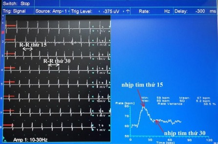 Hình 2 4 Biến thiên nhịp tim bình thường khi thay đổi tư thế Chỉ số 30 15 1 25 4