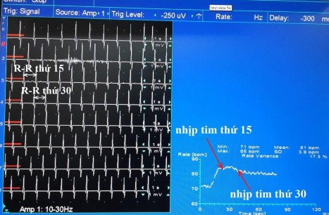 Hình 2 5 Biến thiên nhịp tim bất thường khi thay đổi tư thế Chỉ số 30 15 1 02 5