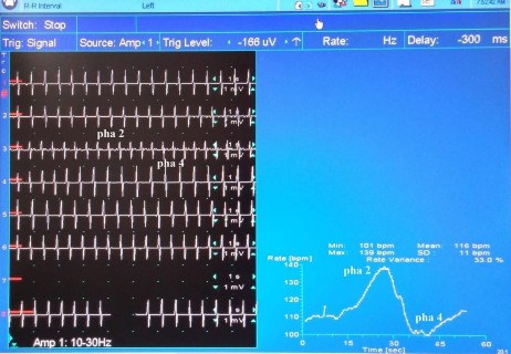 Hình 2 6 Biến thiên nhịp tim bình thường với test Valsalva Chỉ số Valsalva 1 4 6