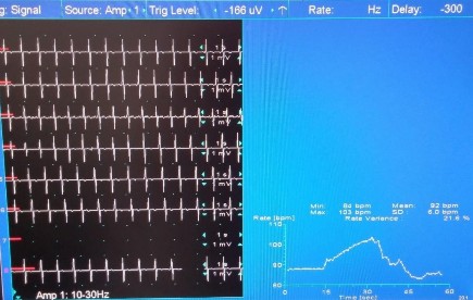 Hình 2 7 Biến thiên nhịp tim bất thường với test Valsalva Chỉ số Valsalva 1 1 7