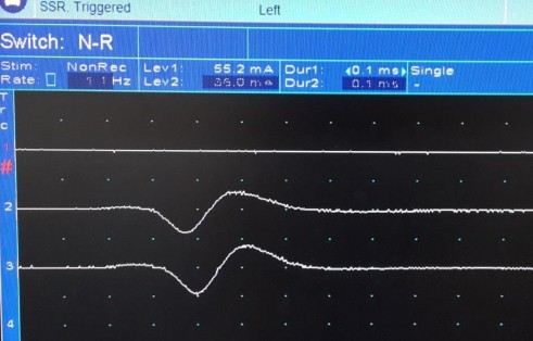 Hình 2 9 Sóng đáp ứng giao cảm da điện cực ở lòng bàn tay và bàn chân Nguồn 9