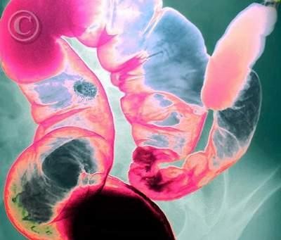 Trùng lông Balantidium coli x ký sinh trong ruột qua phim Xray Trùng lông Balantidium coli 2