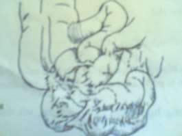 Hình 45 4 Dính ruột Bụng có tham gia theo nhịp thở không Nếu không thường gặp 4