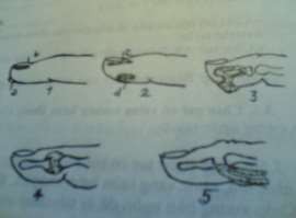 Hình 48 1 Các loại chín mé 1 a Chín mé nốt phỏng 3 Chín mé xương b Chín mé quanh 1