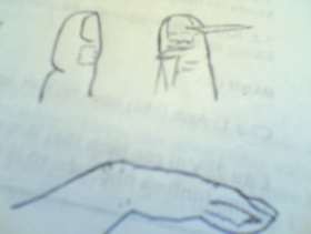 Hình 48 2 Mổ dẫn lưu chín mé 4 2 Xử trí từng trường hợp 4 2 1 Những trường 2