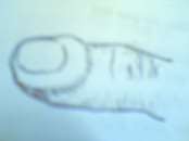 Hình 49 1 Viêm tấy đỏ ửng Hình 49 2 Viêm tấy có nốt phỏng 1 Triệu chứng 1 1 3