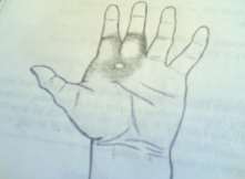 Hình 49 3 Viêm chỗ chai cứng bàn tay Hình 49 4 Viêm tấy gan bàn tay Vùng giữa gan 5