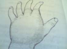 Hình 49 3 Viêm chỗ chai cứng bàn tay Hình 49 4 Viêm tấy gan bàn tay Vùng giữa gan 6