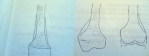 Hình 50 1 Xương bị phá huỷ ở đoạn nối Hình 50 2 Ổ viêm phá vỡ màng Giai 1