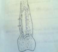 Hình 50 3 Hình xương tù với các lỗ dò Hình 50 4 Các dạng xương tù a b Tù một 2