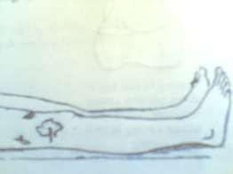 Hình 50 5 Viêm xương mãn có mủ chảy ra 4 2 Chẩn đoán phân biệt 4 2 1 Thấp tim 4