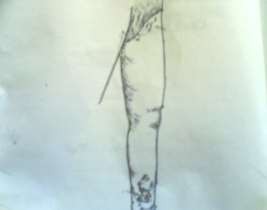 Hình 51 1 Hoại thư chi do vết thương 2 2 Điều kiện thuận lợi Cơ thể bị suy 5