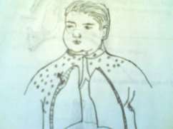 Hình 52 1 Tràn khí dưới da Hình 52 2 Vết thương ngực có van 2 2 2 Vết thương 1