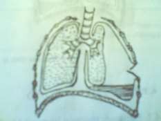 Hình 52 1 Tràn khí dưới da Hình 52 2 Vết thương ngực có van 2 2 2 Vết thương 2