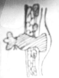 Hình 52 4 Nút gạc trong vết thương ngực mở Phòng chống sốc cho người bệnh 5