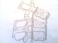 Hình 55 3 Gãy lún Hình 55 4 Gãy và trật khớp Hình 55 5 Gãy làm nhiều mảnh 3 7