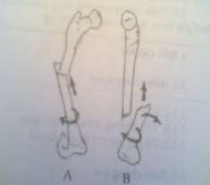 Hình 56 1 Di lệch trong gãy thân xương đùi 2 Triệu chứng lâm sàng 2 1 Triệu 3