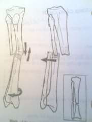 Hình 57 2 Gãy ngang Hình 57 3 Gãy chéo nhiều và xoắn 2 xương 3 2 1 Nhìn Chi bị 4