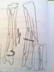 Hình 57 2 Gãy ngang Hình 57 3 Gãy chéo nhiều và xoắn 2 xương 3 2 1 Nhìn Chi bị 5