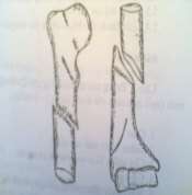 Hình 59 1 Gãy thân xương cánh tay Hình 59 2 Hình ảnh bàn tay rũ cổ cò 4 Biến 1