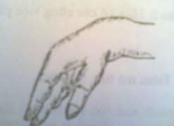 Hình 59 1 Gãy thân xương cánh tay Hình 59 2 Hình ảnh bàn tay rũ cổ cò 4 Biến 2