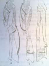 Hình 60 1 Các vị trí di lệch thường gặp trong gãy xương cẳng tay a Gãy cao trên 3