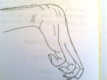 Hình 60 2 Hội chứng Volkman Hình 60 3 Bất động đúng nguyên tắc 5 Xử trí ở 4