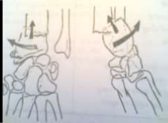 Hình 61 1 Di lệch trong gãy Pouteau Colles 2 Nguyên nhân 2 1 Nguyên nhân trực tiếp Do 1